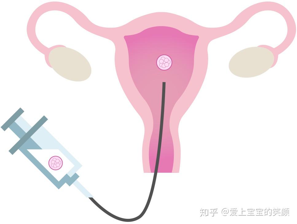 赠卵试管受精卵培育成胚胎需要几天