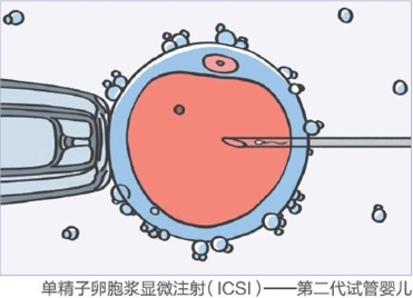 2024年42岁高龄女性试管包生代生代怀男宝儿子成功率有多高（附上成功率）